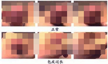 河池男性包皮手术后多久可以好