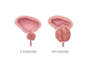 河池前列腺肥大有哪些危害