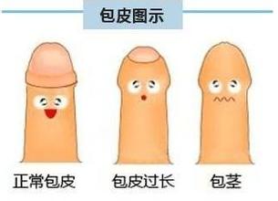 河池那个医院割包皮比较好?