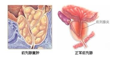 前列腺囊肿具体有哪些表现症状?