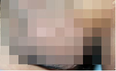 睾丸静脉曲张手术治疗